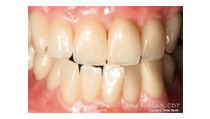 Denti artificiali